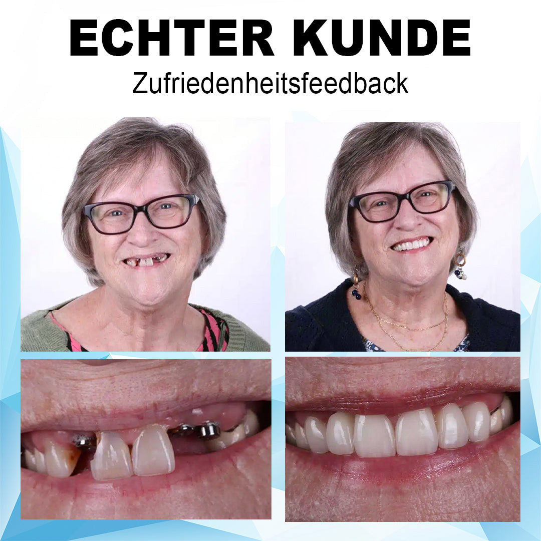 Dobshow ™ Silicone Reline Denture Set(⏰Limited time discount Last 30 minutes⏰)