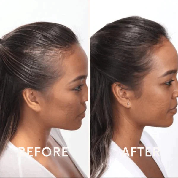 Nurbini™ Mobile Lasertherapie-Kappe für Haarwuchs