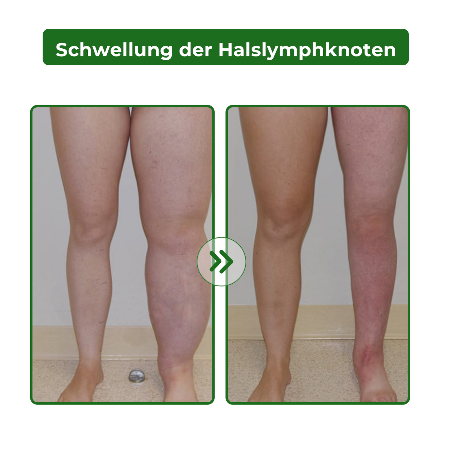 Dobshow® Lymphatische Detox-Kräutercreme|👨⚕️ 𝘿𝙚𝙪𝙩𝙨𝙘𝙝𝙚 𝙂𝙚𝙨𝙚𝙡𝙡𝙨𝙘𝙝𝙖𝙛𝙩 𝙙𝙚𝙪𝙩𝙨𝙘𝙝𝙡𝙖𝙣𝙙 𝙇𝙮𝙢𝙥𝙝𝙤𝙡𝙤𝙜𝙞𝙚, (𝘿𝙂𝙇) 𝙚𝙢𝙥𝙛𝙚𝙝𝙡𝙚