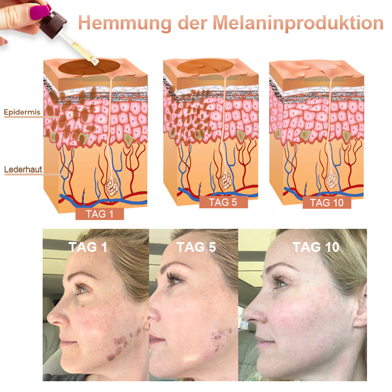 ✨🤩Schnelle Dunkle Flecken Entferner- Dobshow™ Melanin-korrigierendes Gesichtsserum💫