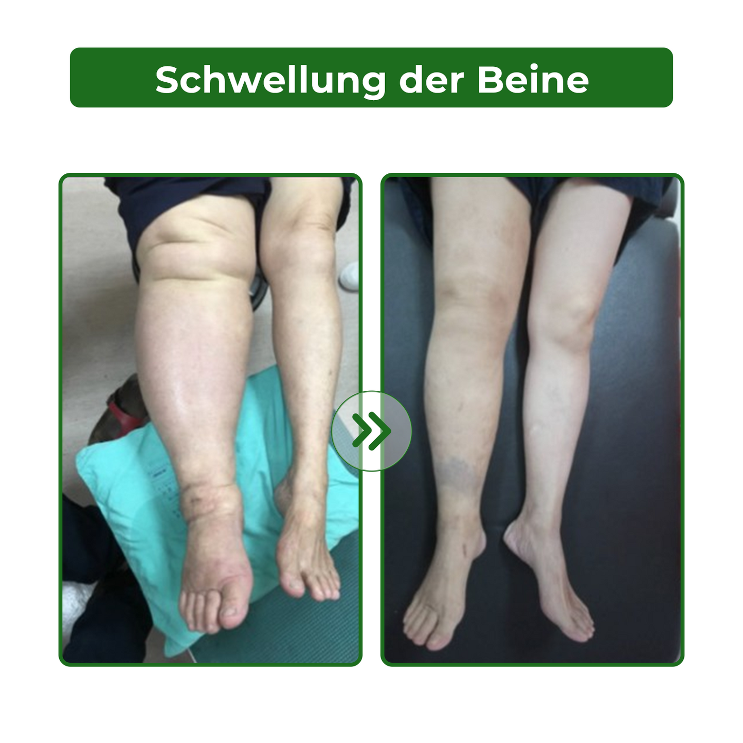 Dobshow® Lymphatische Detox-Kräutercreme|👨⚕️ 𝘿𝙚𝙪𝙩𝙨𝙘𝙝𝙚 𝙂𝙚𝙨𝙚𝙡𝙡𝙨𝙘𝙝𝙖𝙛𝙩 𝙙𝙚𝙪𝙩𝙨𝙘𝙝𝙡𝙖𝙣𝙙 𝙇𝙮𝙢𝙥𝙝𝙤𝙡𝙤𝙜𝙞𝙚, (𝘿𝙂𝙇) 𝙚𝙢𝙥𝙛𝙚𝙝𝙡𝙚