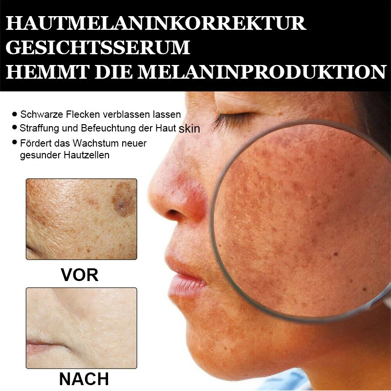✨🤩Schnelle Dunkle Flecken Entferner- Dobshow™ Melanin-korrigierendes Gesichtsserum💫