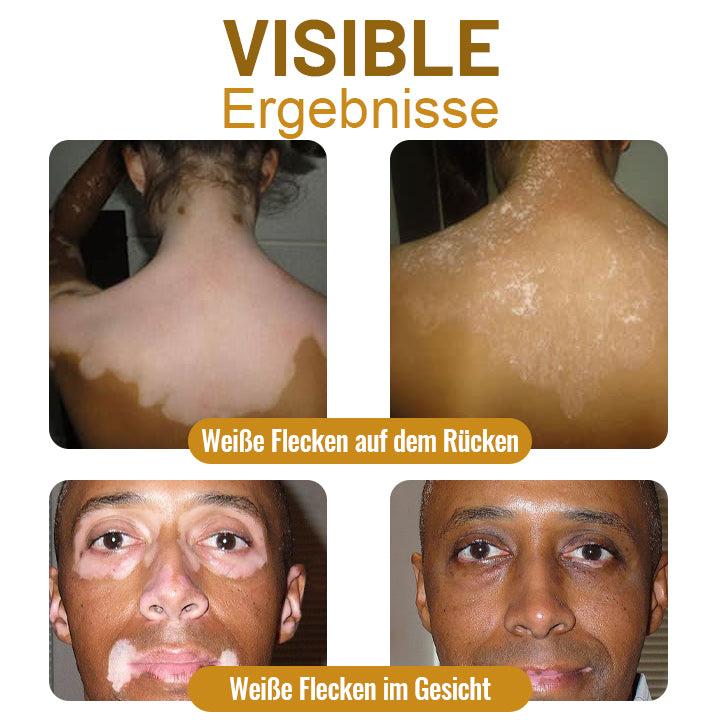 Dobshow™ BeeVenom Vitiligo Behandlungscreme