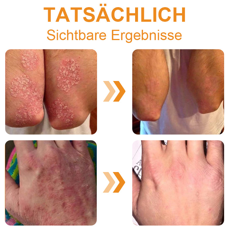 🐝🌿Dobshow™ Bienengift-Psoriasis-Linderungscreme🌿🐝(Wirksam bei allen Hauterkrankungen)🌟