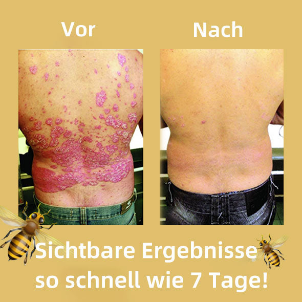 Dobshow™ Bienengift-Psoriasis-Behandlungscreme (Für alle Hautzustände geeignet)
