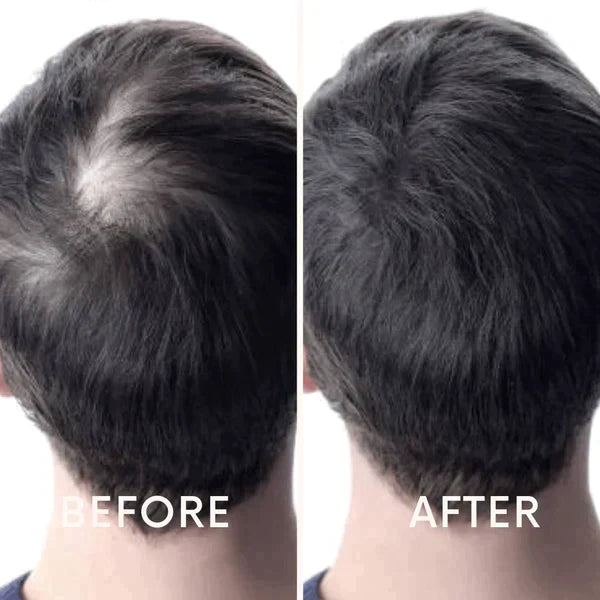 Nurbini™ Mobile Lasertherapie-Kappe für Haarwuchs