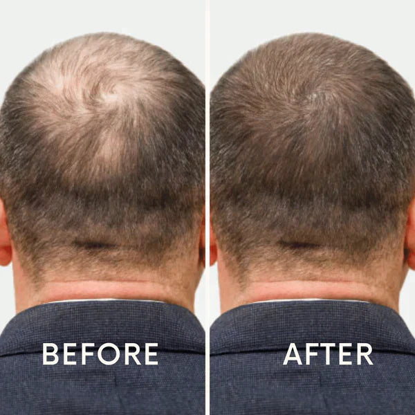 Nurbini™ Mobile Lasertherapie-Kappe für Haarwuchs