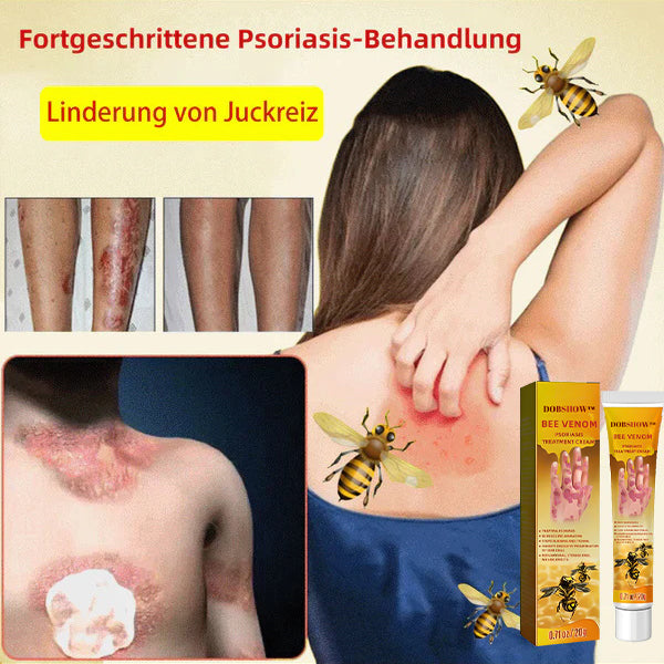 Dobshow™ Bienengift-Psoriasis-Behandlungscreme (Für alle Hautzustände geeignet)