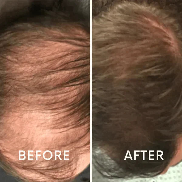 Nurbini™ Mobile Lasertherapie-Kappe für Haarwuchs