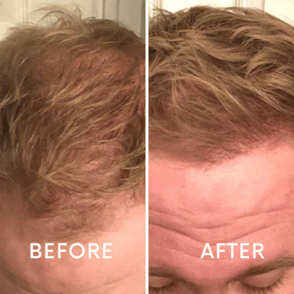 Nurbini™ Mobile Lasertherapie-Kappe für Haarwuchs