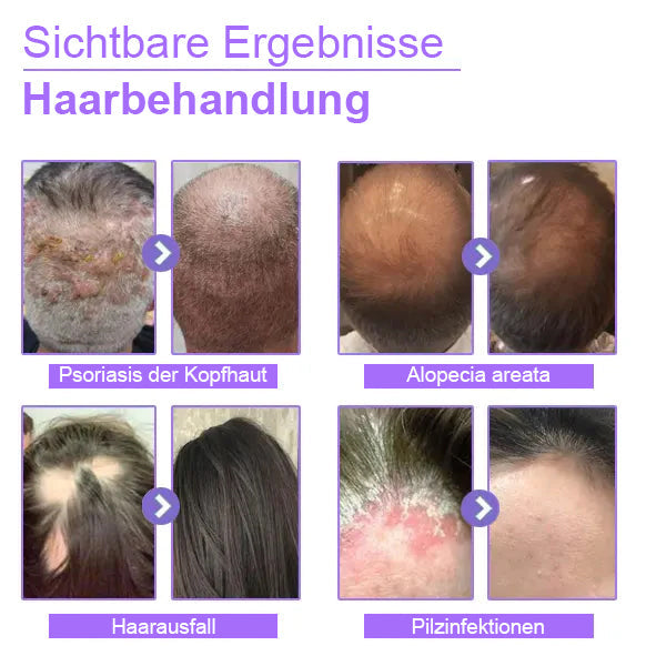 Nurbini™Gouttes de croissance des cheveux réparatrices des follicules pileux - Obtenez rapidement des cheveux plus épais