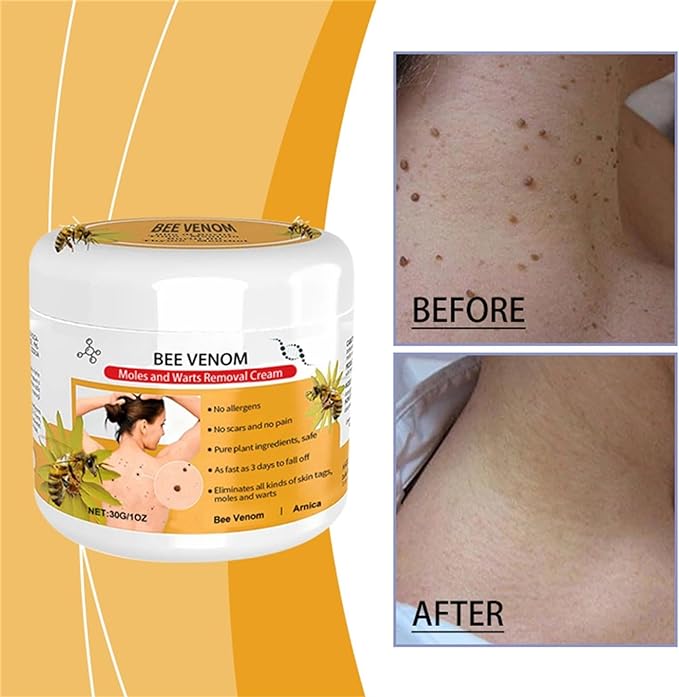 đđ DobshowâąBee Venom Mole und Warze Behandlung Creme(đšââAAD RECOMMENDS)