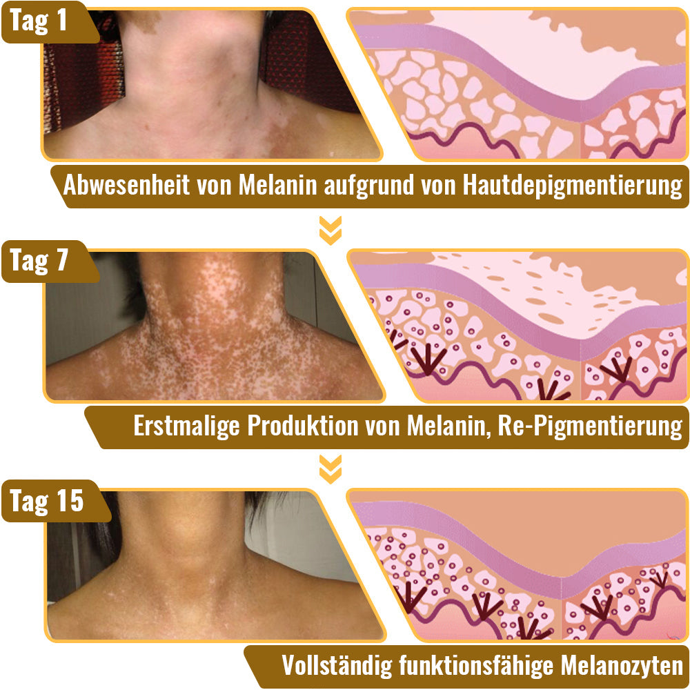 Dobshow™ BeeVenom Vitiligo Behandlungscreme