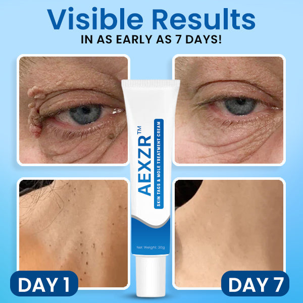 AEXZR™ Creme zur Behandlung von Hautflecken und Muttermalen