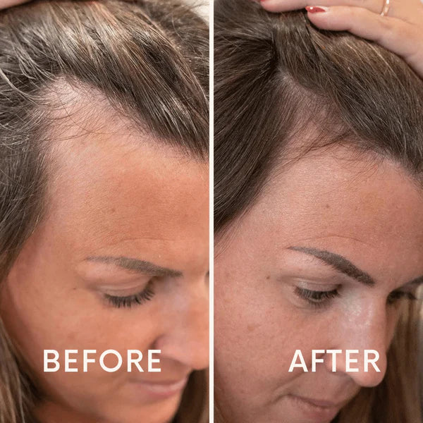 Nurbini™ Mobile Lasertherapie-Kappe für Haarwuchs