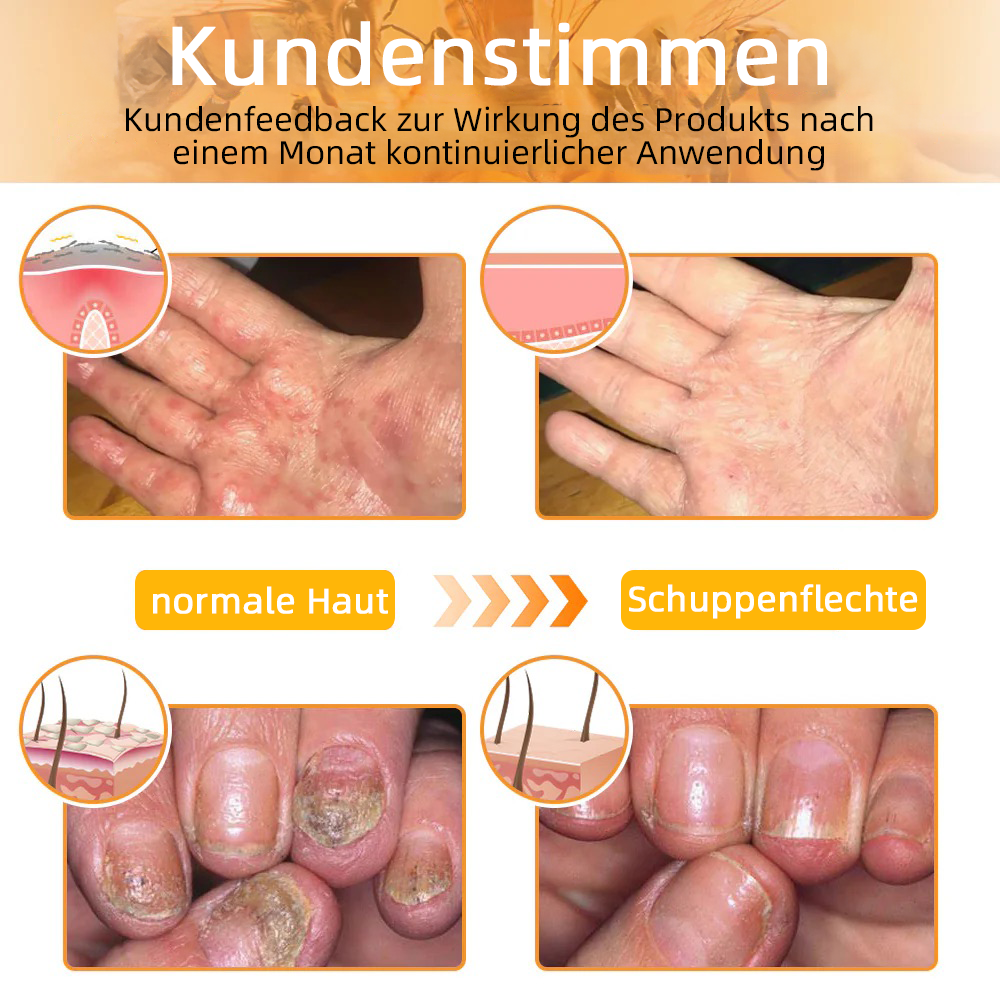 💎Turonu™ Bienengift Hautpflegecreme( BfArM Deutschland)💎