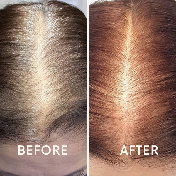 Nurbini™ Mobile Lasertherapie-Kappe für Haarwuchs