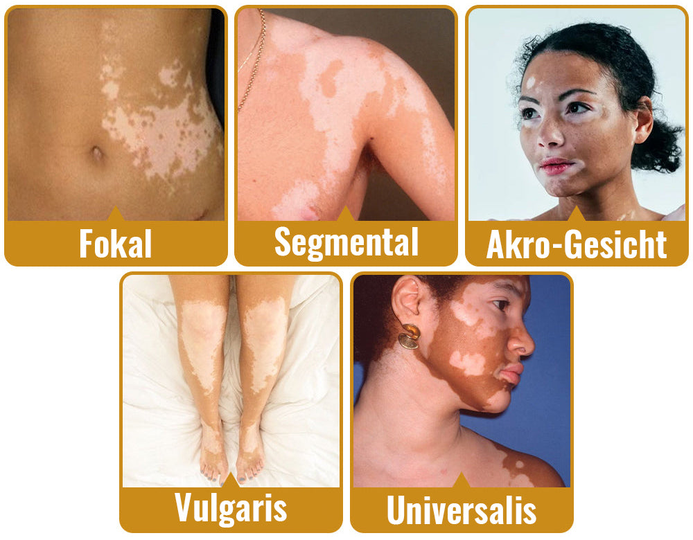 Dobshow™ BeeVenom Vitiligo Behandlungscreme