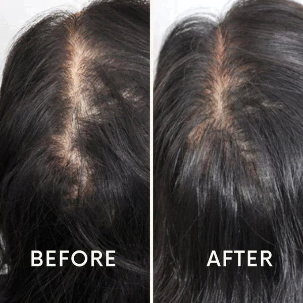 Nurbini™ Mobile Lasertherapie-Kappe für Haarwuchs