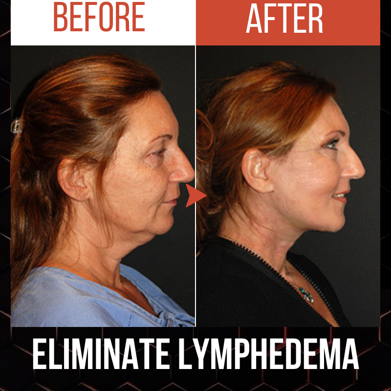SLIMDEX Lymphdrainagegerät für den Hals