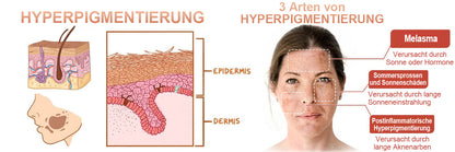 ✨🤩Schnelle Dunkle Flecken Entferner- Dobshow™ Melanin-korrigierendes Gesichtsserum💫