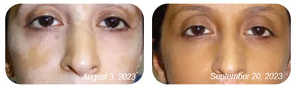 Dobshow™ BeeVenom Vitiligo Treatment Cream