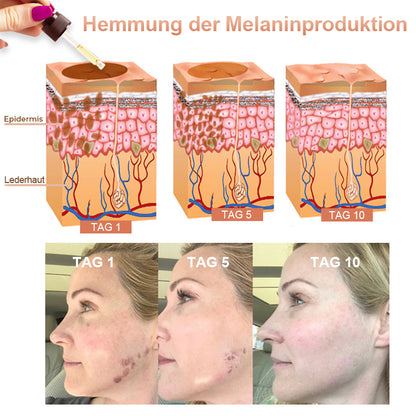 ✨🤩Schnelle Dunkle Flecken Entferner- Dobshow™ Melanin-korrigierendes Gesichtsserum💫