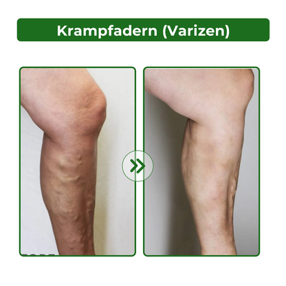 Dobshow® Lymphatische Detox-Kräutercreme|👨‍⚕️ 𝘿𝙚𝙪𝙩𝙨𝙘𝙝𝙚 𝙂𝙚𝙨𝙚𝙡𝙡𝙨𝙘𝙝𝙖𝙛𝙩 𝙙𝙚𝙪𝙩𝙨𝙘𝙝𝙡𝙖𝙣𝙙 𝙇𝙮𝙢𝙥𝙝𝙤𝙡𝙤𝙜𝙞𝙚, (𝘿𝙂𝙇) 𝙚𝙢𝙥𝙛𝙚𝙝𝙡𝙚