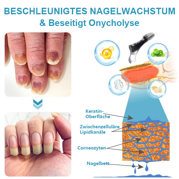 Nurbini™ OnycholysisHeal: Nagelstärkendes und Wachstumsreparatur-Essenz 💅✨