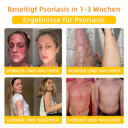💎Turonu™ Bienengift Hautpflegecreme（ BfArM Deutschland）💎