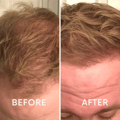 Nurbini™ Mobile Lasertherapie-Kappe für Haarwuchs