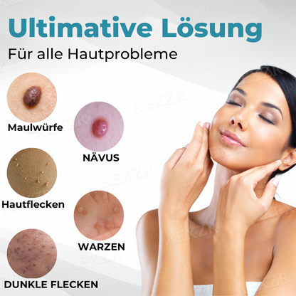 ✨✨Nurbini® Nicht-invasiver Laser-Stift zur Entfernung von Muttermalen und Warzen✨