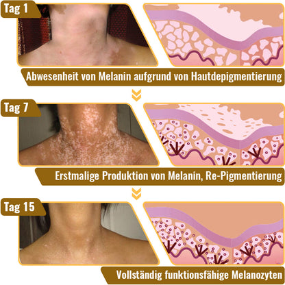 Dobshow™ BeeVenom Vitiligo Behandlungscreme