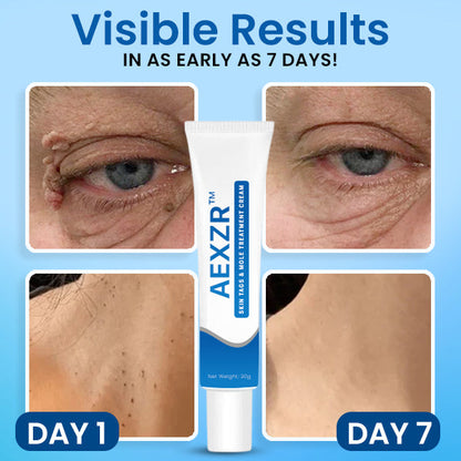 AEXZR™ Creme zur Behandlung von Hautflecken und Muttermalen