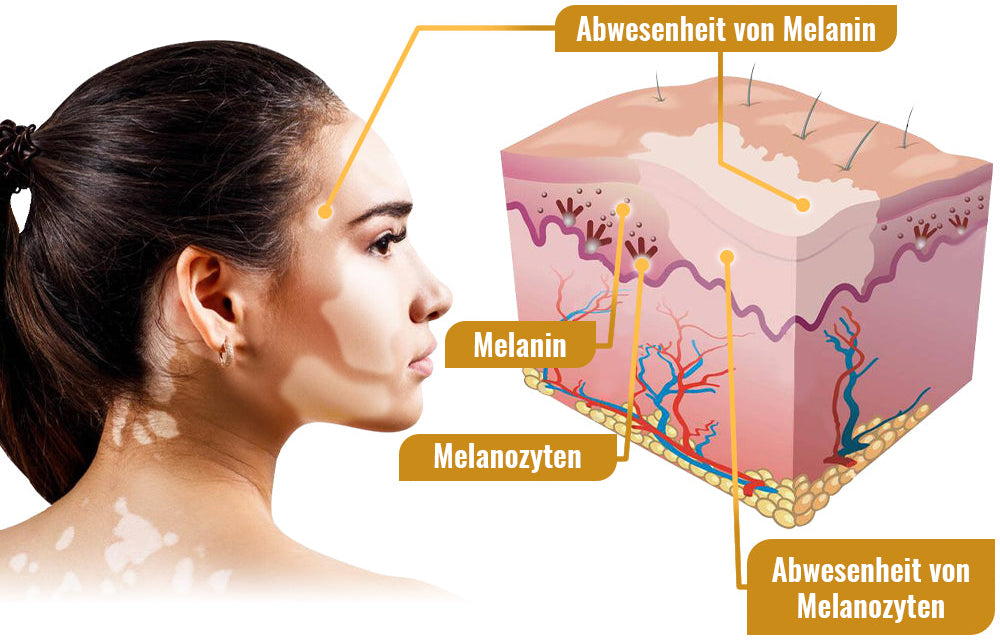 Dobshow™ BeeVenom Vitiligo Behandlungscreme