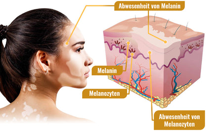 Dobshow™ BeeVenom Vitiligo Behandlungscreme