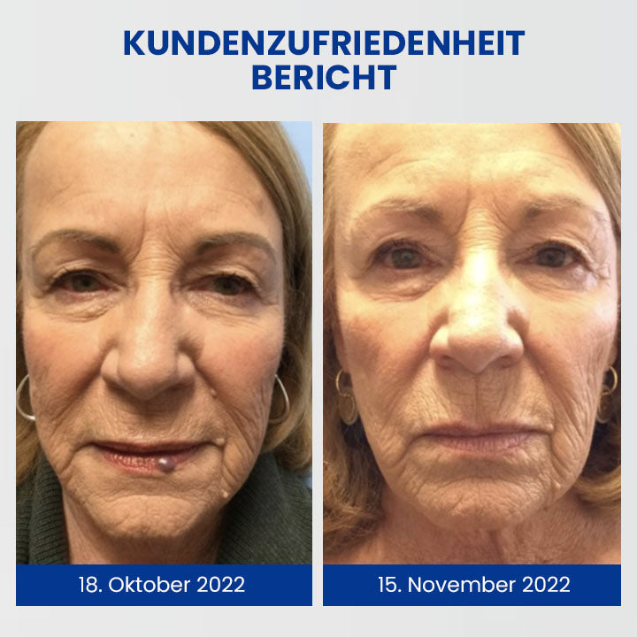 Dobshow™ WartsOff Rapid Creme zur sofortigen Entfernung von Hautunreinheiten