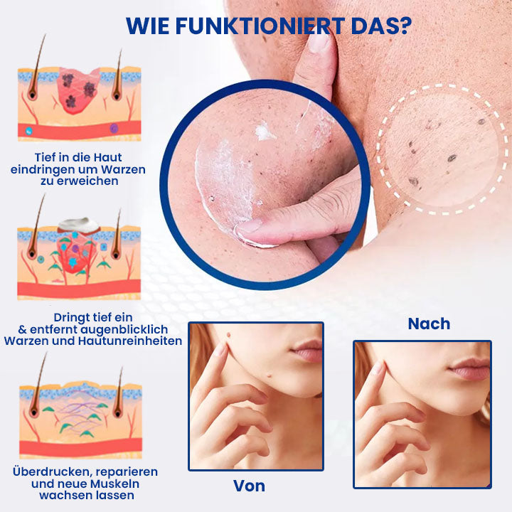 Dobshow™ WartsOff Rapid Creme zur sofortigen Entfernung von Hautunreinheiten