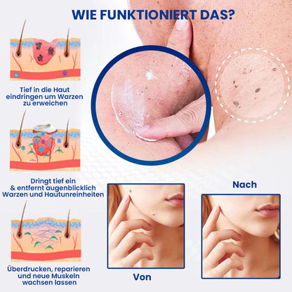 Dobshow™ WartsOff Rapid Creme zur sofortigen Entfernung von Hautunreinheiten