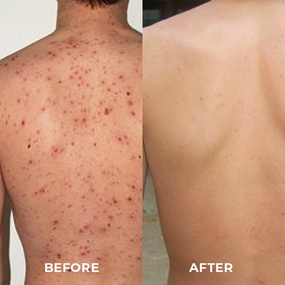 Skinetic™ Reinigungslotion für Akne & Akanthose Nigricans